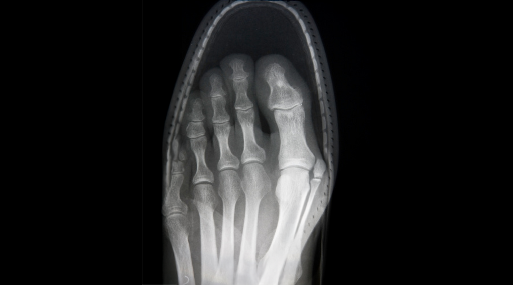 Us vs Your Regular Sneakers: Why Running Shoes Don’t Belong on the Pickleball Court